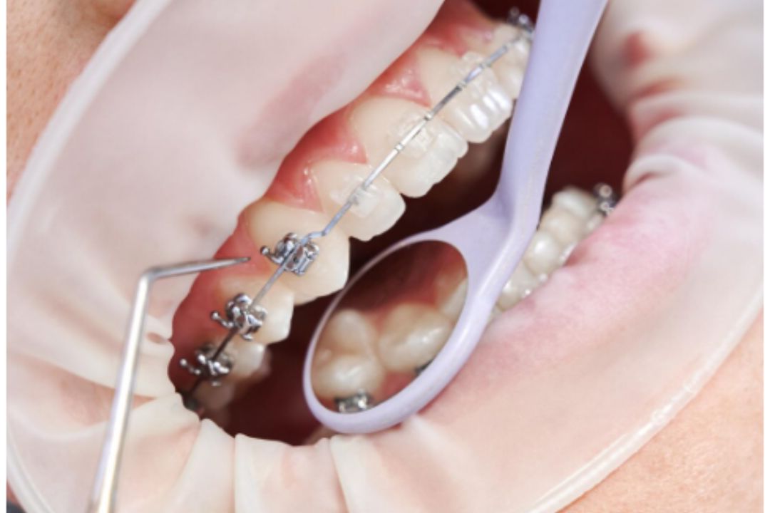 affordable dental braces  near mee 